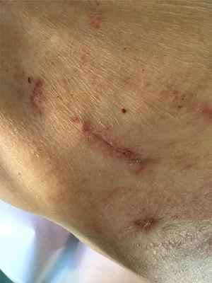 Cicatriz en la piel de la minitoracotomía (3cm) a los 3 meses de seguimiento.