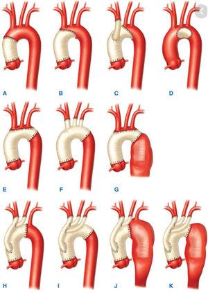 Técnicas quirúrgicas de aorta ascendente y arco.
