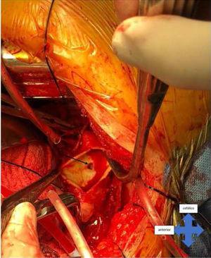 Doble pinzamiento (proximal y distal) y en bypass cardiopulmonar con doble canulación arterial, se realiza aortotomía. La flecha muestra la rotura aórtica en la cara media de la aorta torácica.