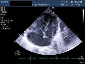 Imagen ecocardiográfica preoperatoria donde se observa el colector y las cavidades izquierdas del corazón que son de reducido tamaño como es habitual en esta cardiopatía.