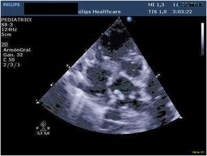 Imagen ecocardiográfica preoperatoria en la que se visualiza la vena vertical.