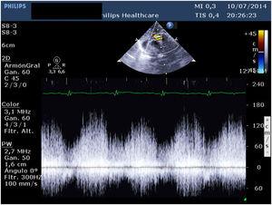 Imagen ecocardiográfica preoperatoria en la que se objetiva el gradiente obstructivo al drenaje pulmonar.