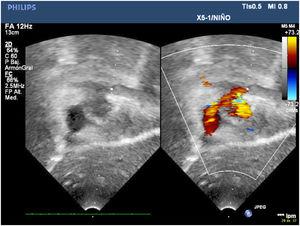 Imagen ecocardiográfica en el seguimiento más reciente en la que se demuestra la conexión amplia entre el colector y la aurícula izquierda.