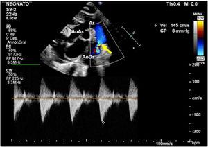 Muestra la ecocardiografía en el momento del nacimiento; la flecha muestra la coartación de aorta sin evidencia de un gradiente significativo. AoAs: aorta ascendente; AoDs: aorta descendente; Ar: arco aórtico.