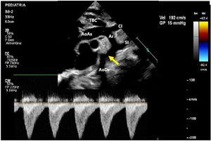 Muestra la ecocardiografía a los 8 días de nacimiento con progresión del gradiente a nivel de la coartación; la flecha señala la coartación de aorta. AoAs: aorta ascendente; AoDs: aorta descendente; Ar: arco aórtico; CI: arteria carótida izquierda; SI: arteria subclavia izquierda; TBC: tronco braquiocefálico.