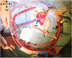 Muestra el abordaje de la esternotomía media (AoAS muestra la cánula de la aorta ascendente; AD la cánula de la aurícula derecha) y la toracotomía postero-lateral izquierda (AoDs la cánula de la aorta descendente; AI la cánula de la aurícula izquierda). Nótese las conexiones en «Y» de las cánulas arteriales (aorta ascendente y descendente) y de las cánulas venosas (aurícula derecha e izquierda). Ca: caudal; Cr: craneal; D: derecha del paciente; I: izquierda del paciente.