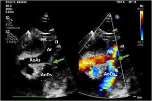 Muestra el ecocardiograma posoperatorio del avance de arco aórtico (flecha) sin evidencia de lesiones residuales. AoAs: aorta ascendente; AoDs: aorta descendente; Ar: arco aórtico; CI: arteria carótida izquierda; TBC: tronco braquiocefálico.