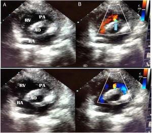 Short axis projection in sonography. It shows continuous flow in diastole (A) and systole (B). The blue arrow marks the fistula location. Its origins appears to be in the interventricular septum and it reaches the right ventricle infundibulum. RA, right auricle; RV, right ventricle. AO, aorta; PA, pulmonary artery.
