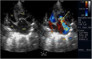 Plano apical de APSI. Se muestra IT severa e hipertrofia severa de VD. AD: aurícula derecha; AI: aurícula izquierda; IT: insuficiencia tricuspídea; VD: ventrículo derecho; VI: ventrículo izquierdo.