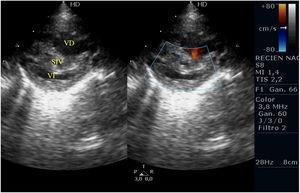 Plano paraesternal eje corto de APSI donde se observa una hipertrofia severa de VD y «aplastamiento» sistólico del mismo al VI. SIV: septo interventricular; VD: ventrículo derecho; VI: ventrículo izquierdo.