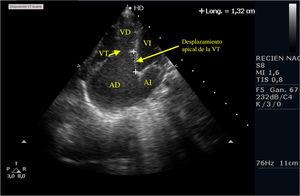 Plano apical de la anomalía de Ebstein. Se muestra la dilatación de la AD y la inserción apical de la VT. AD: aurícula derecha; AI: aurícula izquierda; IT: insuficiencia tricuspídea; VD: ventrículo derecho; VI: ventrículo izquierdo; VT: válvula tricuspídea.