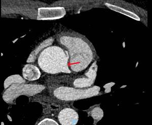 Coronary computed tomography angiography patient 1. Coronary computed tomography angiography showing an anomalous right coronary artery originating anterosuperiorly from the left coronary sinus. An intramural course towards the left coronary sinus can be appreciated (red arrow).