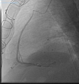 Coronary angiography image patient 2. Coronary angiography image showing the saphenous vein graft with distal anastomosis to the distal right coronary artery before the crux cordis. The patency of the graft can be appreciated.