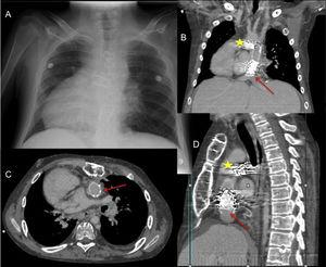 Varón de 20 años con failing Fontan en dextrocardia y con eje de cava a la izquierda. (A) Radiografía posteroanterior de tórax. Tomografía computarizada cardíaca con imágenes coronal (B), transversal (C) y sagital (D): La flecha señala el stent del conducto de Fontan a nivel de la anastomosis con la vena cava inferior, y la estrella el stent en la bifurcación pulmonar. En el trasplante, el corazón donante se acomodó en levocardia abriendo ambas pleuras longitudinalmente, se utilizó el conducto del Fontan una vez extraído el stent para conectar la cava inferior con la aurícula derecha, se desmontó el doble Glenn con anastomosis de esas venas a las venas cava superior e innominada del donante, se reconstruyeron las ramas pulmonares, los pedículos de aorta y pulmonar se dejaron largos.