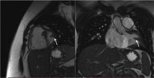 Imagen de resonancia magnética preoperatoria. Se observa dilatación importante de cavidades derechas. La flecha blanca señala el músculo papilar único.