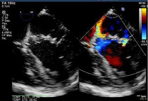 Persistencia de IM en base del cleft mitral en ecocardiograma transesofágico intraoperatorio.
