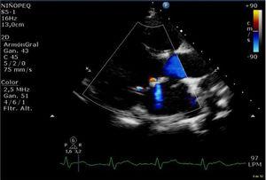 Ecocardiograma transtorácico a los 2 meses de la intervención.