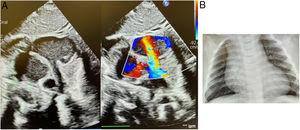 A) Ecocardiografía que muestra estructura tubular drenando en aurícula derecha. B) RX de tórax: dilatación de aurícula derecha.