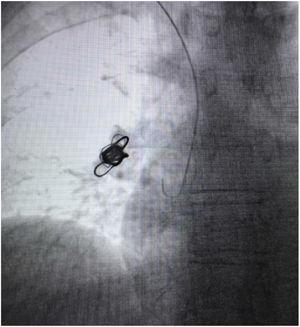 Angiogram showed completely displaced coil nest in the chest.