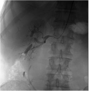 Selective angiography of the right orthotopic kidney.