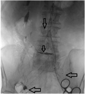 Main body endograft deployed, crossed kidney chimney (upper arrow), embolization of the lower renal pole (middle arrow), embolization of the right hypogastric artery (lower left arrow), correction of the left iliac aneurysm with bell bottom (lower right arrow).