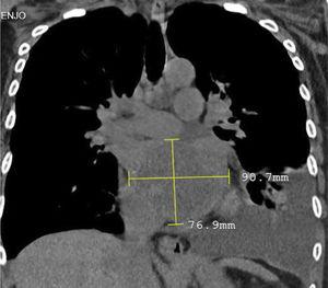 TAC de tórax: masa intracardíaca izquierda con derrame pleural ipsilateral.