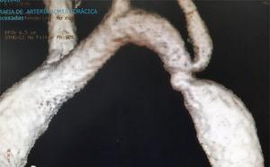 Angio-TAC con imagen de recoartación posdilatación percutánea.