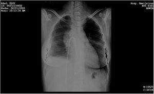 Radiografía de tórax PA con el catéter en aurícula derecha.