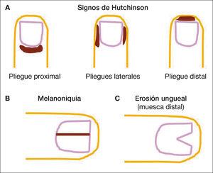 Esquemas del signo de Hutchinson (A), melanoniquia (B) y erosión ungueal (C). El signo de Hutchinson es una pigmentación de la piel que rodea la uña. En la melanoniquia observamos una banda recta que se extiende de pliegue proximal a distal incluido. En una erosión ungueal vemos destrucción/desaparición de la uña a nivel distal.