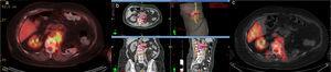 Mujer de 70 años con masa metastásica paraespinal en L1 de carcinoma renal que le producía dolor. a) PET-TC diagnóstico (14/01/13). SUV entre 9-10 b) Planning de tratamiento: SBRT T11-L3. Dosis total 15Gy (3Gy por fracción) + boost integrado 25Gy (5Gy por fracción en la periferia) + boost integrado 40Gy (8Gy/fracción en la zona central de la lesión). c) PET-TC seguimiento (15/05/13). SUV 1.9. Buen control sintomático. PET-TC: tomografía por emisión de positrones (positron emission tomography)-tomografía computarizada; SBRT: radioterapia estereotáxica (stereotactic body radiatontherapy); SUV: valores de captación estandarizados (standardized uptake values).