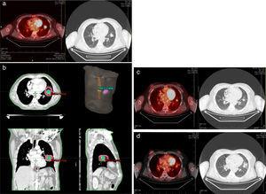 Varón de 57 años con cáncer de pulmón. Presentó síntomas respiratorios como dolor torácico y disnea. a) PET-TC diagnóstica (10/04/14): SUV 5.9. b) Planning de tratamiento SBRT. Dosis total: 48Gy (12Gy/fracción). c) PET-TC de seguimiento (27/07/14). SUV 1.9. d) PET-TC de seguimiento (20/11/14). SUV 1.2. Desaparición de los síntomas desde el inicio del tratamiento. PET-TC: tomografía por emisión de positrones (positron emission tomography)-tomografía computarizada; SBRT: radioterapia estereotáxica corporal (stereotactic body radiatontherapy); SUV: valores de captación estandarizados (standardized uptake values).