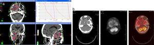 Mujer de 92 años con carcinoma de células claras de antro maxilar derecho con invasión del lóbulo temporal derecho y silla turca, así como fosa craneal media derecha y órbita ipsilateral, con masa adyacente y probable invasión de músculos extraoculares. Intenso dolor en región afectada. a) Planning de tratamiento (septiembre de 2010): SBRT. DT 25Gy (5Gy por fracción en 5 fracciones). b) PET-TC de seguimiento (septiembre de 2010): disminución del tamaño y actividad metabólica de la lesión. Asintomática. PET: tomografía por emisión de positrones (positron emission tomography); SBRT: radioterapia estereotáxica corporal (stereotactic body radiatontherapy); TC: tomografía computarizada.