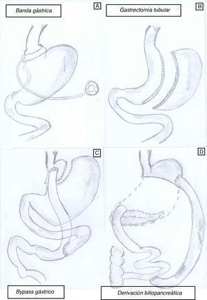 Técnicas de cirugía bariátrica más representativas. Restrictivas: banda gástrica ajustable (A) y gastrectomia tubular (B). Mixtas: bypass gástrico (C) y derivación biliopancreática (D). Diseño de Eric y Debra Burguera.