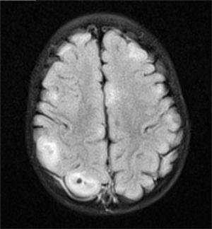 Resonancia magnética cerebral en secuencia Flair, donde se observan túberes corticales.