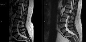 Sección sagital de RM de 2011 (izquierda) y de 2015 (derecha) que reveló una gran hernia de disco en L1-L2, causante de una compresión significativa del saco dural y del cono medular.