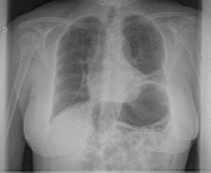 Radiografía de tórax simple donde se evidencia elevación del hemidiafragma izquierdo con hipoventilación basal compatible con parálisis o paresia frénica, y un estómago distendido con un gran nivel hidroaéreo en su interior.