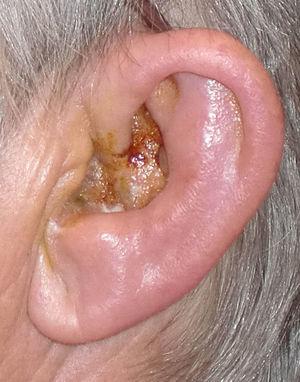 Se observan las lesiones ampollosas en pabellón auricular. (Fotografía propia; de 15 x 6cm, sensibilidad a 8 Pix).