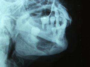 Radiografía mandibular de la paciente. (M. Martínez Morentin, J.M. Echeveste).