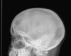 Radiografía de cráneo.