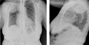 Radiografía de tórax AP y lat.: imagen de aspecto masa bien delimitada en zona apical y lóbulo superior del pulmón derecho.