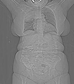 Tomografía axial computarizada (TAC) tóraco-abdominal: gran masa en el lóbulo superior del pulmón derecho, que desplaza mediastino, compresión de la traquea y el esófago, adenopatías metastásicas supraclaviculares derechas.