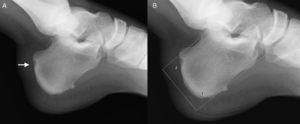 Radiografía lateral de tobillo.A) La flecha señala una lesión lítica en la cortical.B) La tuberosidad posterosuperior supera la línea superior según el método PPL y se puede considerar deformidad de Haglund.