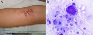 A) Múltiples vesículas arracimadas sobre base eritematosa, en la cara posterolateral de la pierna derecha, que producían prurito y escozor. B) Cambios citopáticos típicos de la infección por Herpesvirus, con presencia de células gigantes multinucleadas.