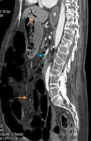 Signos radiológicos de isquemia mesentérica: trombo en arteria mesentérica superior (flecha azul), aire en venas mesentéricas y porta intrahepática (flechas naranjas).