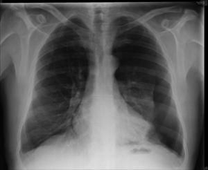 Radiografía de tórax donde se observa neumotórax izquierdo. Fuente: Servicio de Radiología del Hospital General de La Palma.