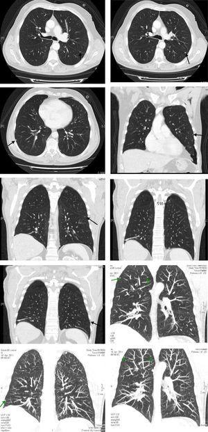 TC de tórax donde se observan varios nódulos en ambos pulmones y en la pleura (flechas). Fuente: Servicio de Radiología del Hospital General de La Palma.