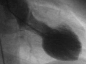 La coronariografía no muestra lesiones coronarias. En la ventriculografía se objetiva una disfunción del VI con hipocinesia, acinesia o discinesia de los segmentos apicales con hipercontractilidad de los basales, dando como resultado la balonización durante la sístole.