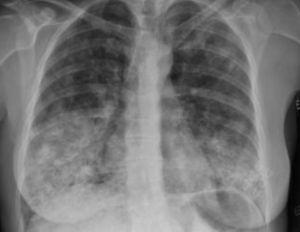 Radiografía de tórax al ingreso con infiltrados bilaterales bronquioalveolares de predominio bibasales e imágenes de aspecto nodulares bilaterales.