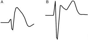 A) El patrón diagnóstico electrocardiográfico del síndrome de Brugada (tipo 1) se caracteriza por un ascenso del ST igual o superior a 2mm cóncavo con respecto a la línea de base, con pendiente descendente seguido de T negativa. B) El patrón tipo 2 es sugestivo y necesita de fármacos bloqueadores de los canales del sodio para poder confirmar el diagnóstico de síndrome de Brugada. En este patrón podemos identificar en V1 y V2 una verdadera r’ a una altura de 0,2mV seguida de un ascenso del ST mayor e igual a 0,5mm convexo con respecto a la línea de base, seguida por T positiva en V2 tomando la morfología denominada «silla de montar».