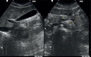 Corte longitudinal en el hipocondrio derecho visualizando vesícula (1). Corte transversal en epigastrio visualizando el páncreas (2), vena esplénica (3) y arteria mesentérica superior (4).